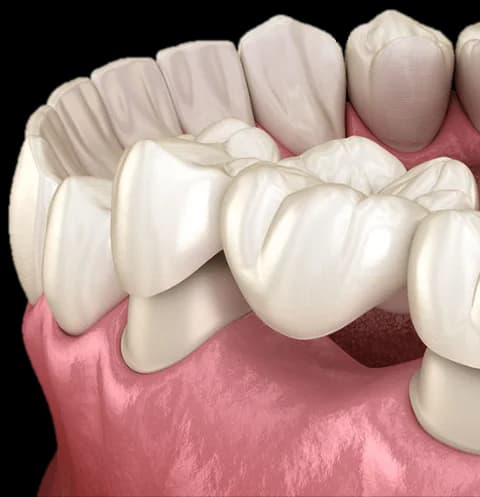 Monolithic Zirconia Crown