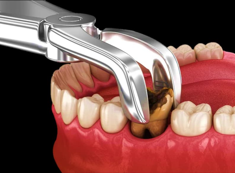 Atraumatic Tooth Extraction