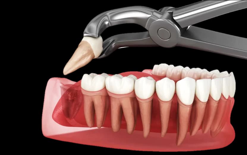 Impacted Wisdom Tooth X-Ray