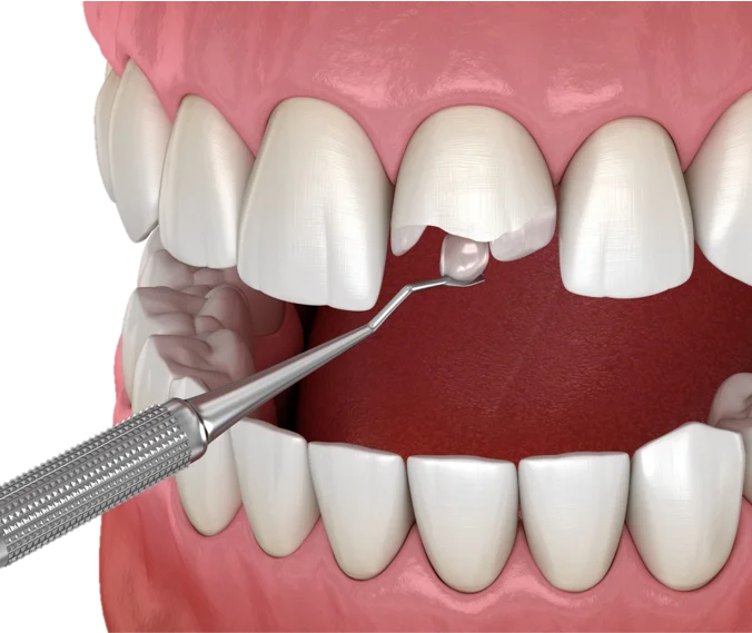 Cosmetic Bonding in Hyderabad - Noble Dental Care