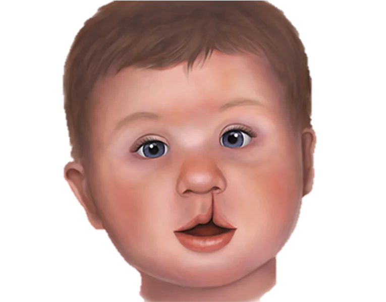 Cleft Lip and Palate Care in Hyderabad - Noble Dental Care