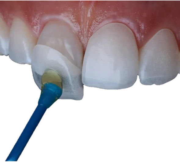 Cosmetic Dentistry in Hyderabad - Noble Dental Care