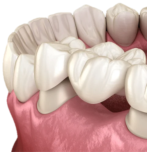 Crowns & Bridges in Hyderabad - Noble Dental Care