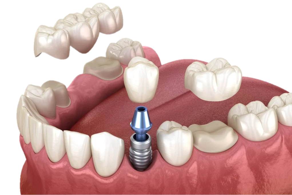 Dental Bridges in Hyderabad - Noble Dental Care