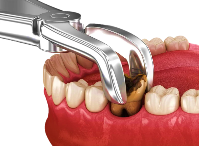 Tooth Extraction in Hyderabad - Noble Dental Care