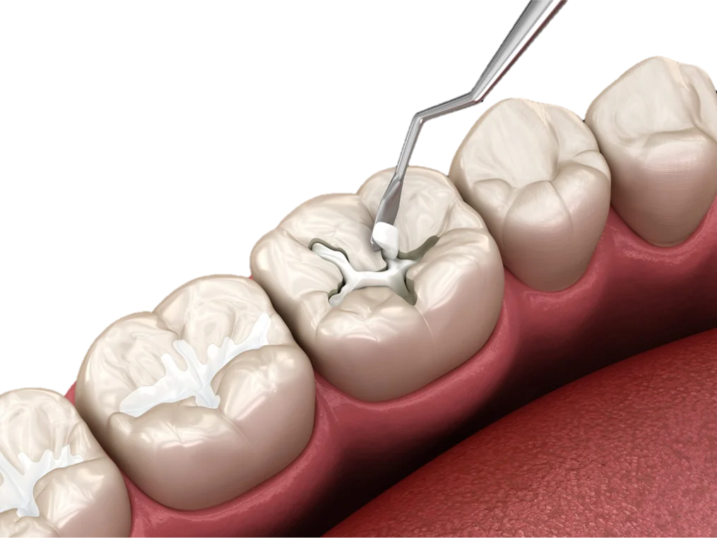 Dental Fillings in Hyderabad - Noble Dental Care