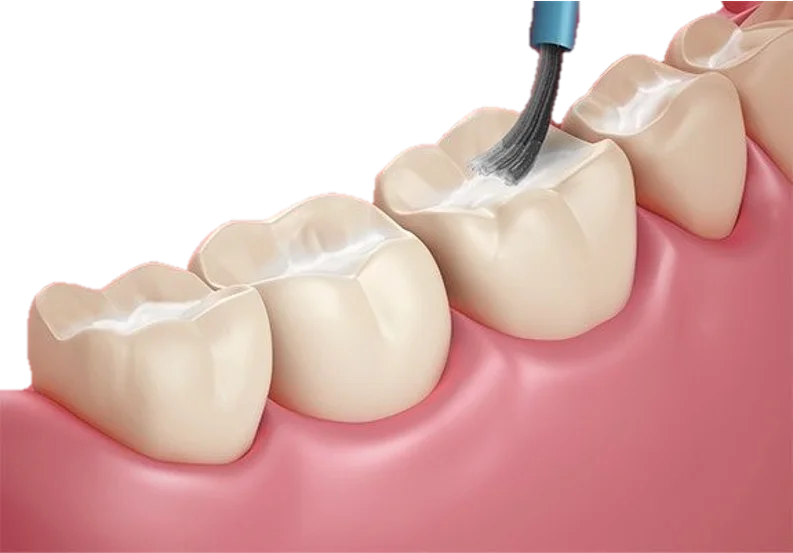 Fluoride Therapy in Hyderabad - Noble Dental Care