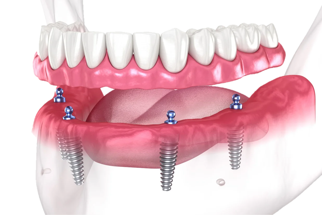 Full Mouth Rehabilitation in Hyderabad - Noble Dental Care