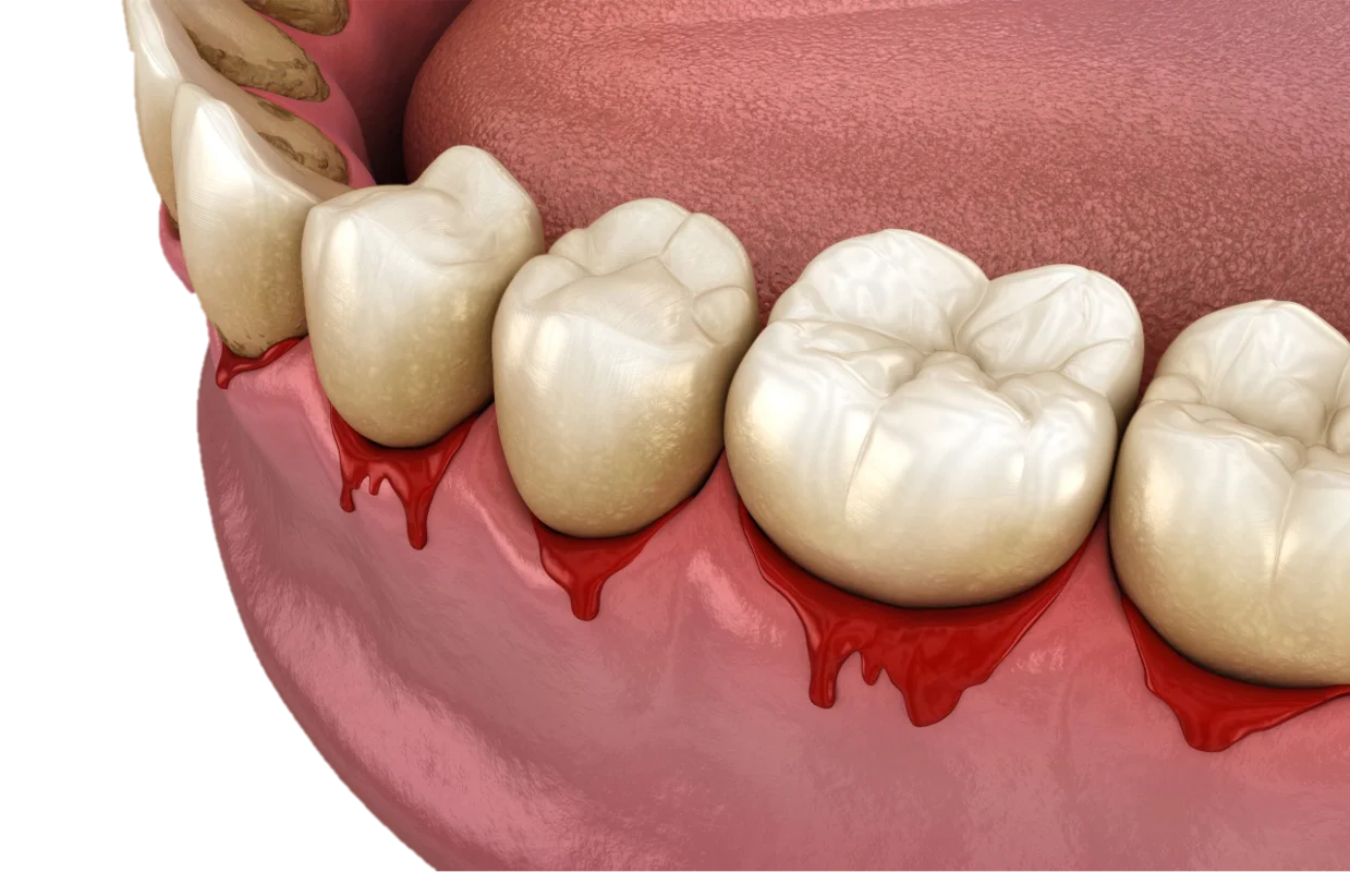 Gum Disease Treatment in Hyderabad - Noble Dental Care
