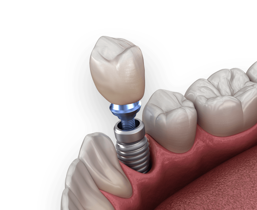 Dental Implants in Hyderabad - Noble Dental Care