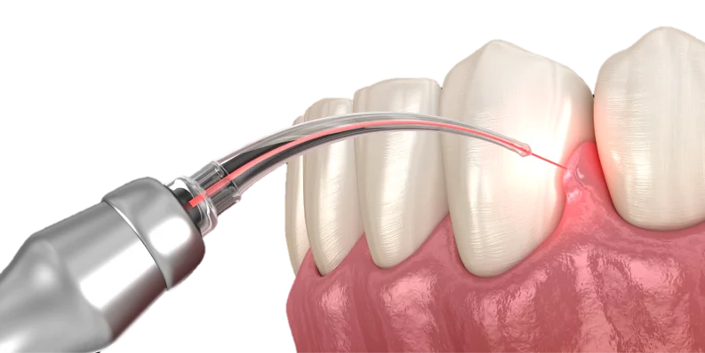 Laser Dentistry in Hyderabad - Noble Dental Care