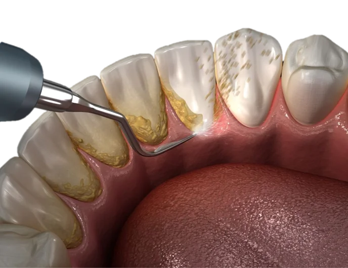 Oral Prophylaxis in Hyderabad - Noble Dental Care