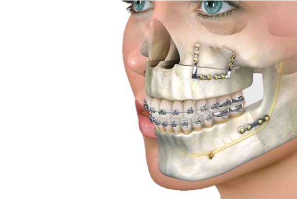 Orthognathic Jaw Surgery in Hyderabad - Noble Dental Care