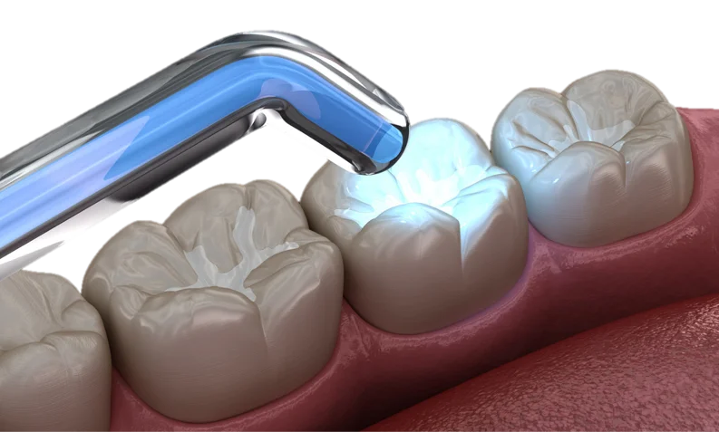Preventive Dental Sealants in Hyderabad - Noble Dental Care