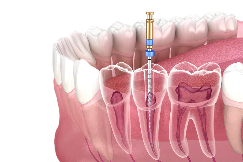 Painless Root Canal Treatment in Hyderabad - Noble Dental Care