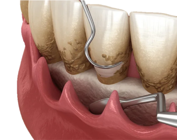 Dental Scaling & Polishing in Hyderabad - Noble Dental Care