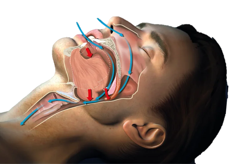 Sleep Apnea Treatment in Hyderabad - Noble Dental Care