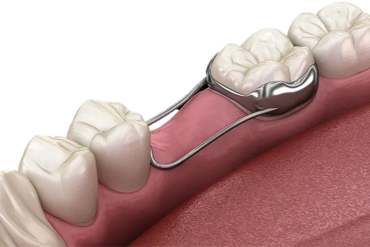 Space Maintainers for Kids in Hyderabad - Noble Dental Care