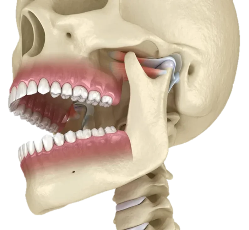 TMJ Disorder Treatment in Hyderabad - Noble Dental Care
