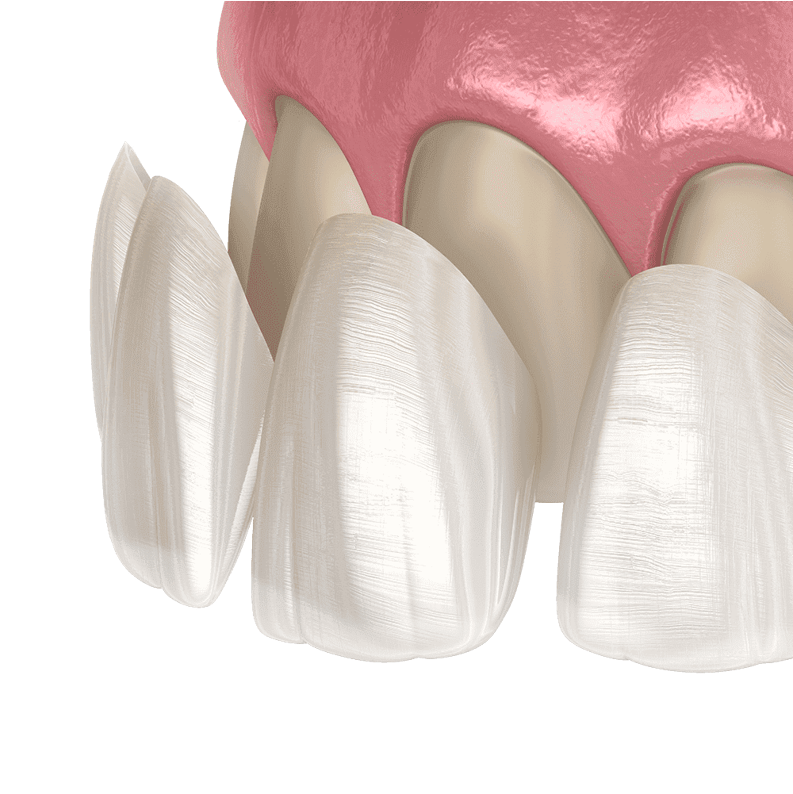 Dental Veneers in Hyderabad - Noble Dental Care