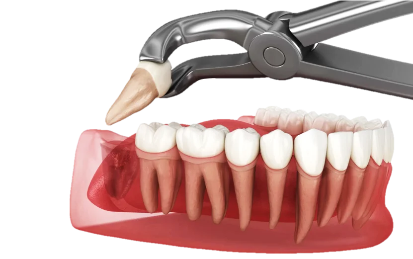 Wisdom Tooth Surgery in Hyderabad - Noble Dental Care